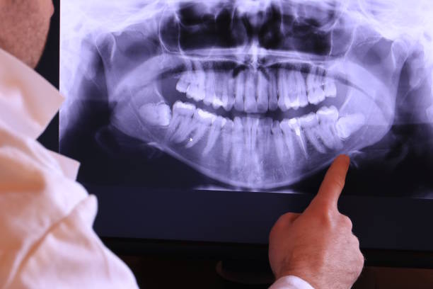 Best Emergency Wisdom Teeth Removal in Clinton, MS