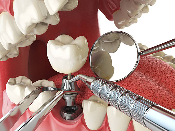 Best Emergency Root Canal Treatment in Clinton, MS